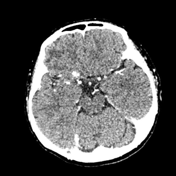Cerebral ring enhancing lesions - cerebral metastases (Radiopaedia 44922-48818 B 109).jpg