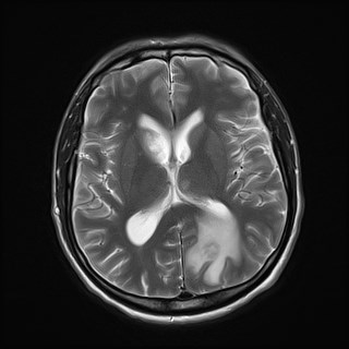 File:Cerebral toxoplasmosis (Radiopaedia 43956-47461 Axial T2 12).jpg