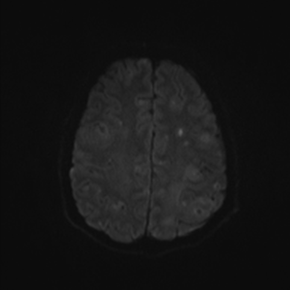 Cerebral toxoplasmosis (Radiopaedia 53993-60132 Axial DWI 47).jpg