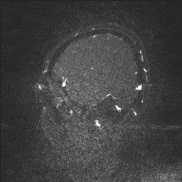 Cerebral tuberculosis with dural sinus invasion (Radiopaedia 60353-68090 Sagittal MRV 16).jpg