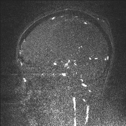 Cerebral tuberculosis with dural sinus invasion (Radiopaedia 60353-68090 Sagittal MRV 57).jpg