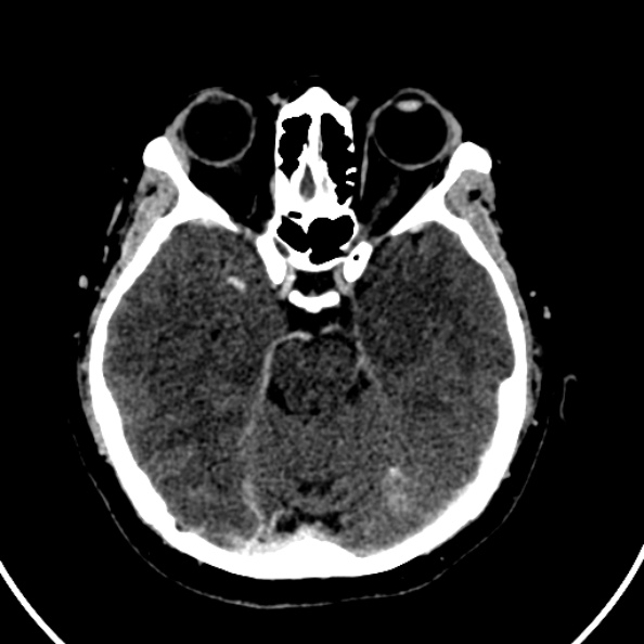 Cerebral venous hemorrhagic infarct from venous sinus thrombosis (Radiopaedia 55433-61883 Axial C+ delayed 98).jpg