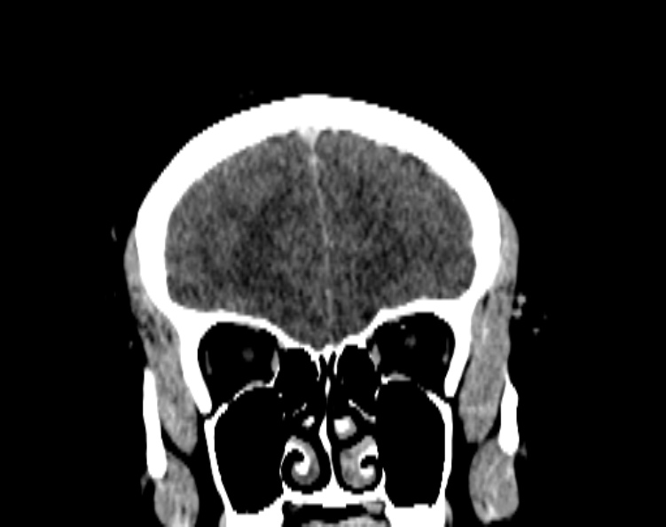 Cerebral venous hemorrhagic infarct from venous sinus thrombosis (Radiopaedia 55433-61883 Coronal C+ delayed 19).jpg