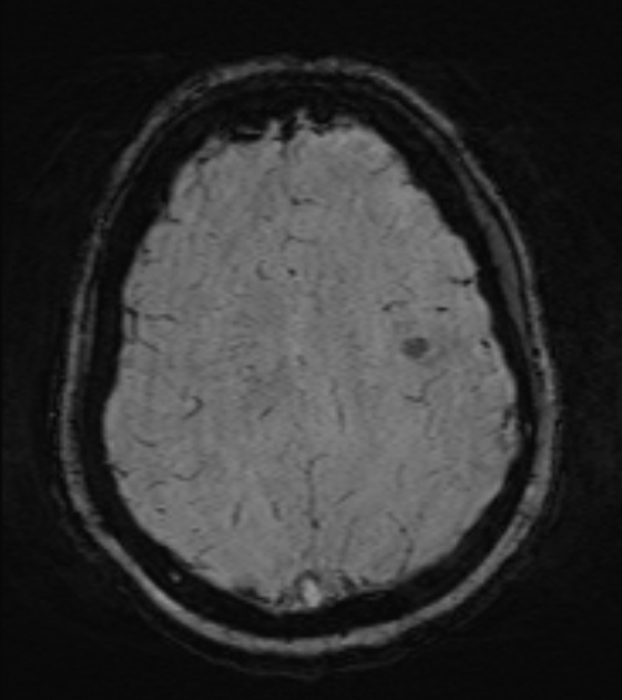 Cerebral venous infarct (Radiopaedia 53627-59685 Axial SWI 40).jpg