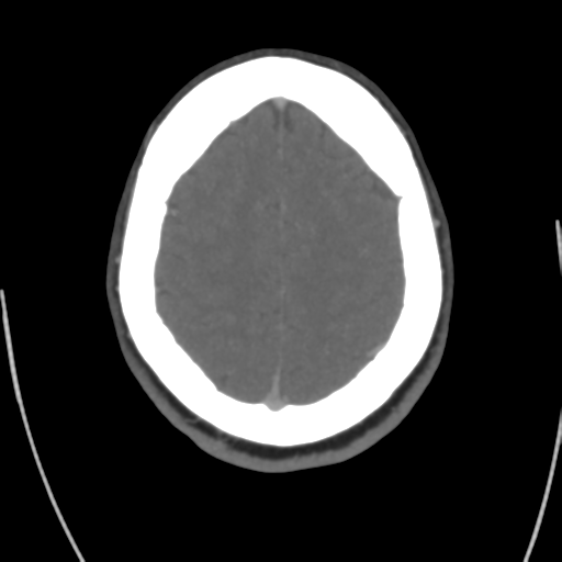 Cerebral venous infarct related to dural venous sinus thromboses (Radiopaedia 35292-36804 Axial C+ delayed 39).png
