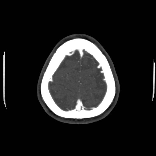 Cerebral venous sinus thrombosis (Radiopaedia 40619-43227 A 205).jpg