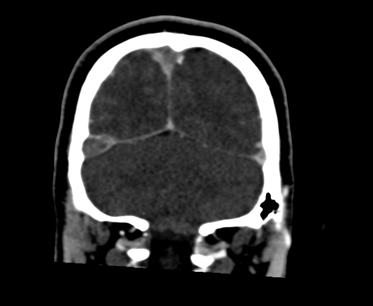 Cerebral venous sinus thrombosis (Radiopaedia 59224-66646 Coronal C+ delayed 64).jpg