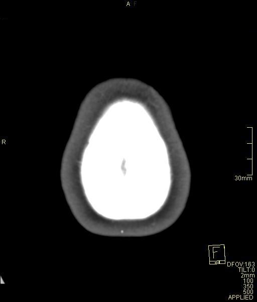 Cerebral venous sinus thrombosis (Radiopaedia 91329-108965 Axial venogram 76).jpg