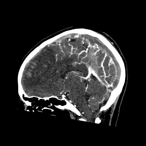 File:Cerebral venous throbmosis - hemorrhagic venous infarction (Radiopaedia 87318-103613 Sagittal CT venogram 24).jpg