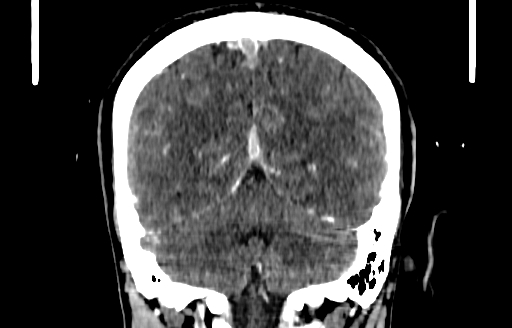 Cerebral venous thrombosis (CVT) (Radiopaedia 77524-89685 C 47).jpg