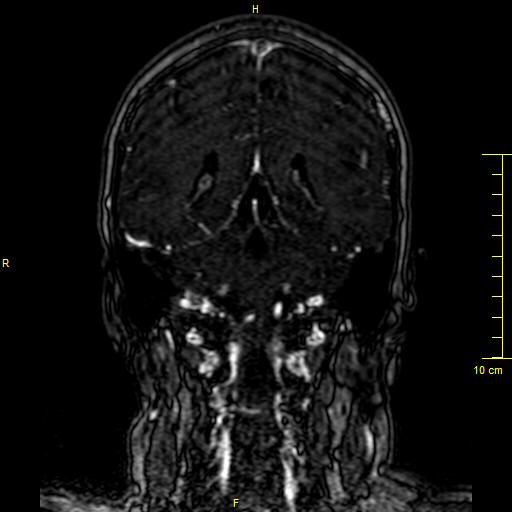 Cerebral venous thrombosis (Radiopaedia 23288-23351 MRV 106).JPG