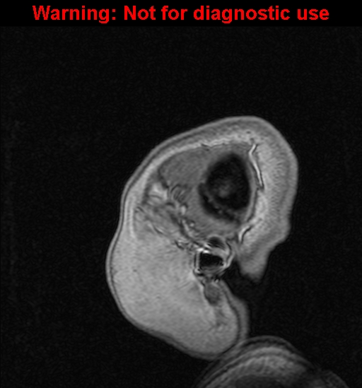 Cerebral venous thrombosis (Radiopaedia 37224-39208 Sagittal T1 C+ 7).jpg