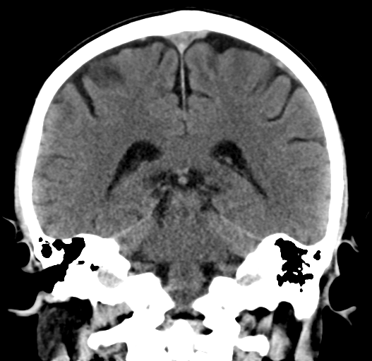 File:Cerebral venous thrombosis (Radiopaedia 38392-40467 Coronal non-contrast 24).png