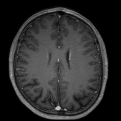Cerebral venous thrombosis (Radiopaedia 38392-40469 Axial T1 C+ 52).png