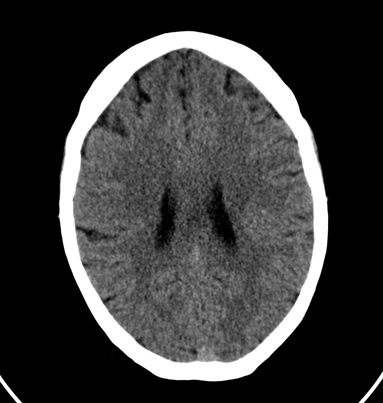 Cerebral venous thrombosis - CT only (Radiopaedia 41031-43778 Axial non-contrast 30).jpg