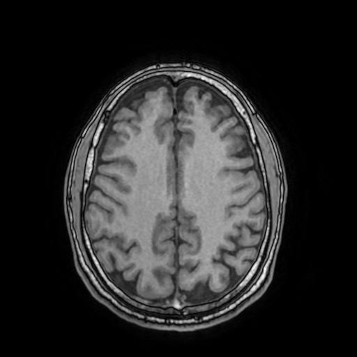 Cerebral venous thrombosis with secondary intracranial hypertension (Radiopaedia 89842-106957 Axial T1 121).jpg