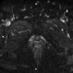 File:Cervical adenocarcinoma (Radiopaedia 65011-73985 Axial DWI 10).jpg