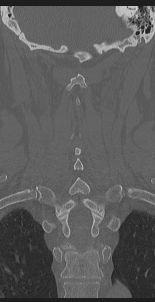 Cervical canal stenosis due to ossification of the posterior longitudinal ligament (Radiopaedia 47260-51823 Coronal bone window 44).png