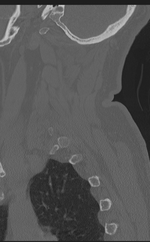 Cervical canal stenosis due to ossification of the posterior longitudinal ligament (Radiopaedia 47260-51823 Sagittal bone window 64).png