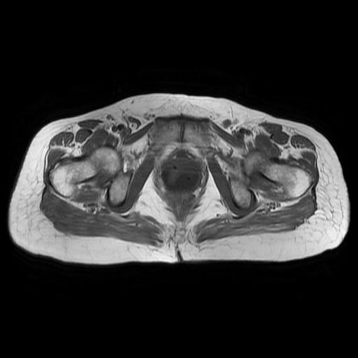 File:Cervical carcinoma (Radiopaedia 67644-77047 Axial T1 17).jpg
