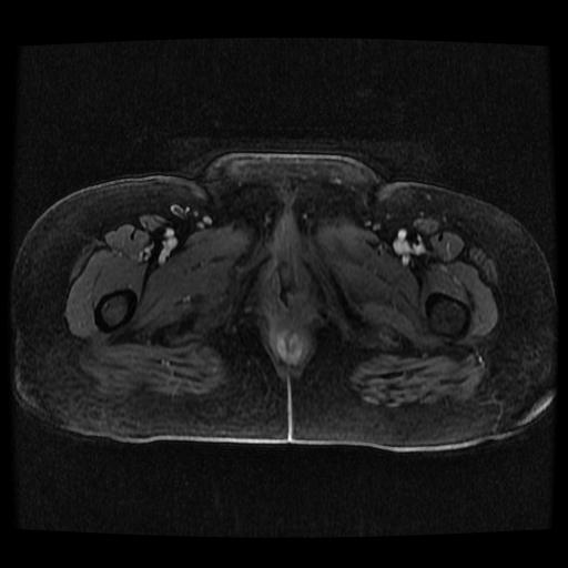 File:Cervical carcinoma (Radiopaedia 70924-81132 Axial T1 C+ fat sat 18).jpg