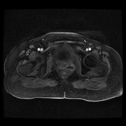 Cervical carcinoma (Radiopaedia 70924-81132 Axial T1 C+ fat sat 34).jpg