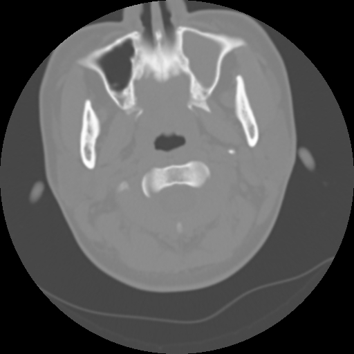 Cervical rib (Radiopaedia 71110-81363 Axial non-contrast 19).jpg