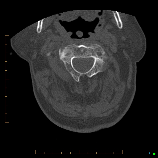 Cervical spine fracture - ankylosing spondylitis (Radiopaedia 76835-88706 Axial bone window 56).jpg