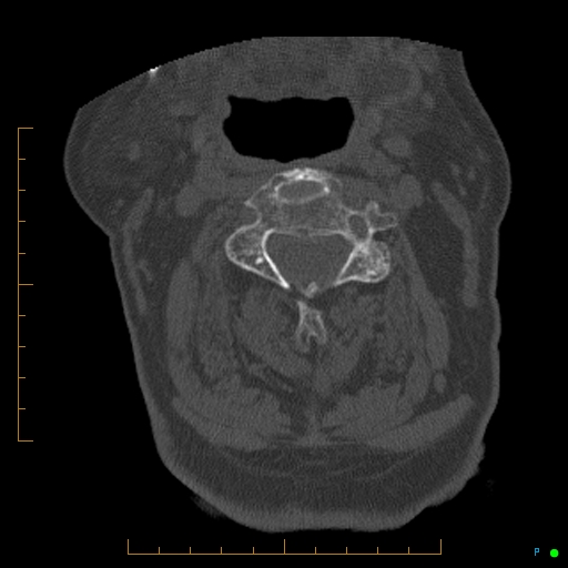 Cervical spine fracture - ankylosing spondylitis (Radiopaedia 76835-88706 Axial bone window 84).jpg