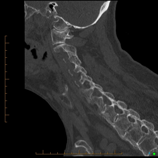Cervical spine fracture - ankylosing spondylitis (Radiopaedia 76835-88706 Sagittal bone window 41).jpg