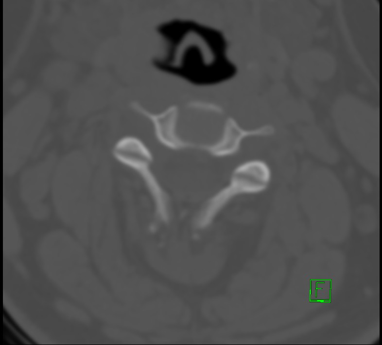 Cervical spine fracture - hyperflexion injury (Radiopaedia 66184-75364 Axial bone window 12).jpg