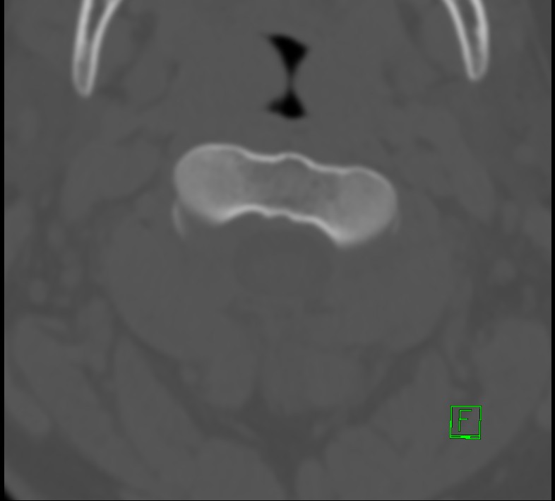 Cervical spine fracture - hyperflexion injury (Radiopaedia 66184-75364 Axial bone window 4).jpg