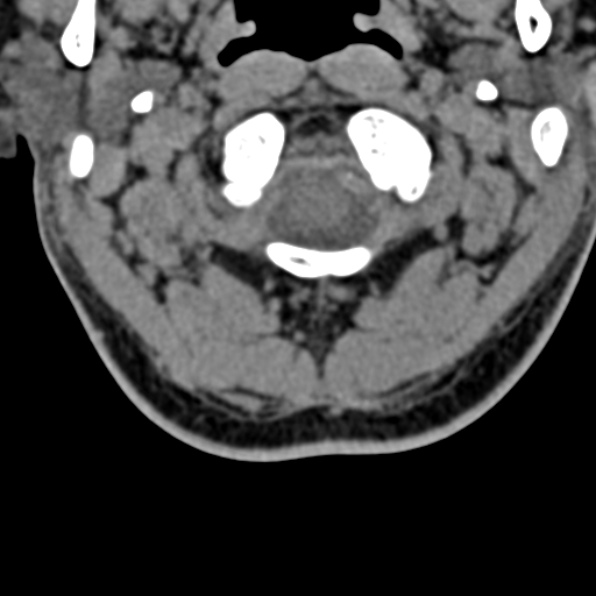 Cervical spondylodiscitis (Radiopaedia 28057-29489 Axial non-contrast 14).jpg
