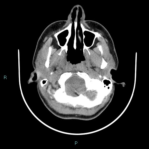 File:Cervical thymic cyst (Radiopaedia 88632-105335 Axial non-contrast 101).jpg