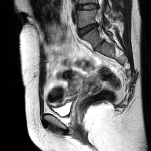 File:Cesarian section scar endometriosis (Radiopaedia 66520-75799 Sagittal T2 3).jpg