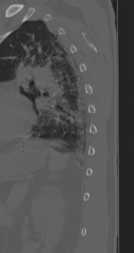 Chance fracture (Radiopaedia 33854-35020 Sagittal bone window 12).png