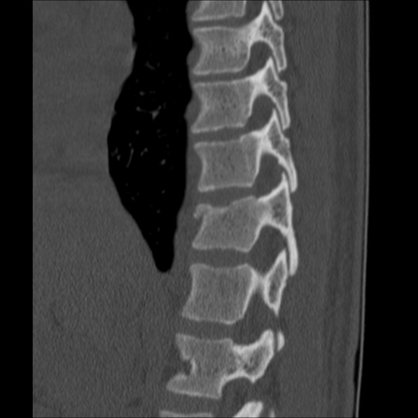 Chance fracture (Radiopaedia 36521-38081 Sagittal bone window 20).jpg