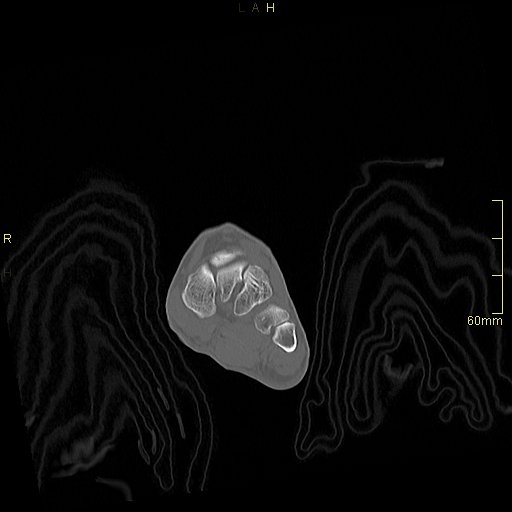 Chaput tubercle fracture (Radiopaedia 80319-93956 Coronal non-contrast 15).jpg