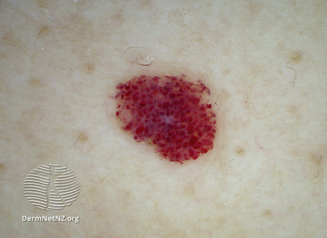 File:Cherry angioma 4 dermoscopic (DermNet NZ 152889).jpg