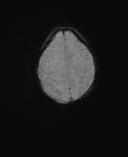 Chiari III malformation with occipital encephalocele (Radiopaedia 79446-92559 Axial SWI 50).jpg