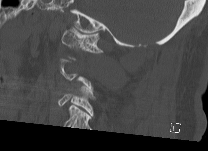 Chiari I malformation with a symptomatic syrinx of the posterolateral medulla oblongata (Radiopaedia 42573-45707 A 42).jpg