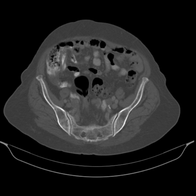 Cholangiocarcinoma (Radiopaedia 50592-56025 Axial bone window 56).jpg