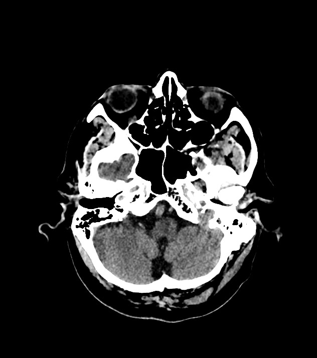 Cholangiocarcinoma with cerebral metastases (Radiopaedia 83519-98628 Axial non-contrast 17).jpg
