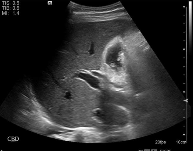 File:Cholecystitis - perforated gallbladder (Radiopaedia 57038-63913 A 5).jpg