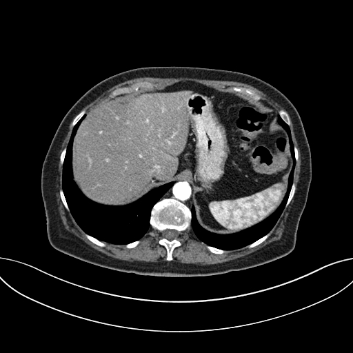 Cholecystoduodenal fistula due to calculous cholecystitis with gallstone migration (Radiopaedia 86875-103077 A 15).jpg