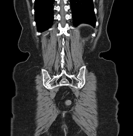 File:Cholecystoduodenal fistula due to calculous cholecystitis with gallstone migration (Radiopaedia 86875-103077 B 40).jpg