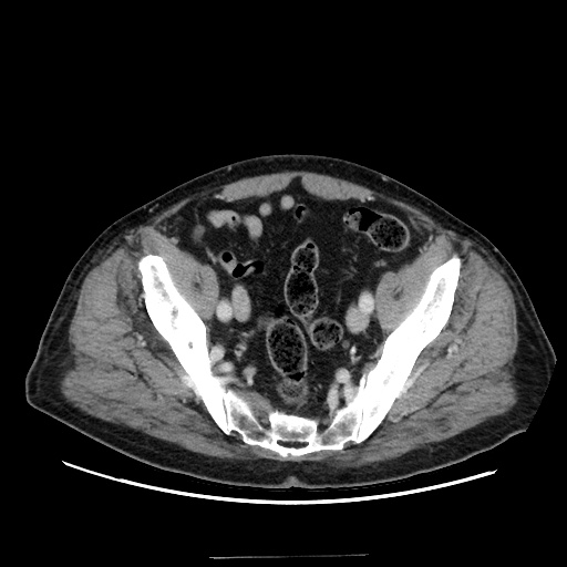 Choledocholiathiasis with normal caliber common bile duct (Radiopaedia 75368-86632 A 159).jpg