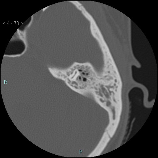File:Cholesterol granuloma of the petrous apex (Radiopaedia 64358-73141 Axial bone window 36).jpg