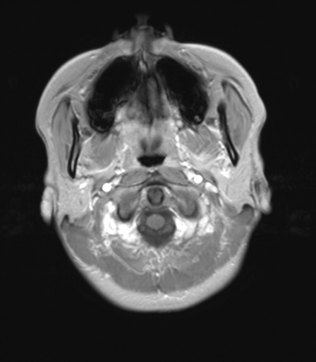 File:Chondrosarcoma (Radiopaedia 41937-44939 Axial T1 C+ 1).png