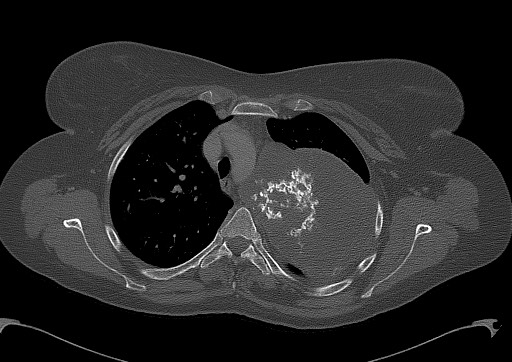 Chondrosarcoma - chest wall (Radiopaedia 65192-74199 Axial bone window 40).jpg